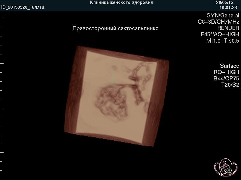 3D-фото сактосальпинкса. Стрелкой указана правая маточная труба, расширенная и запаянная 3D-фото сактосальпинкса. Стрелкой указана правая маточная труба, расширенная и запаянная