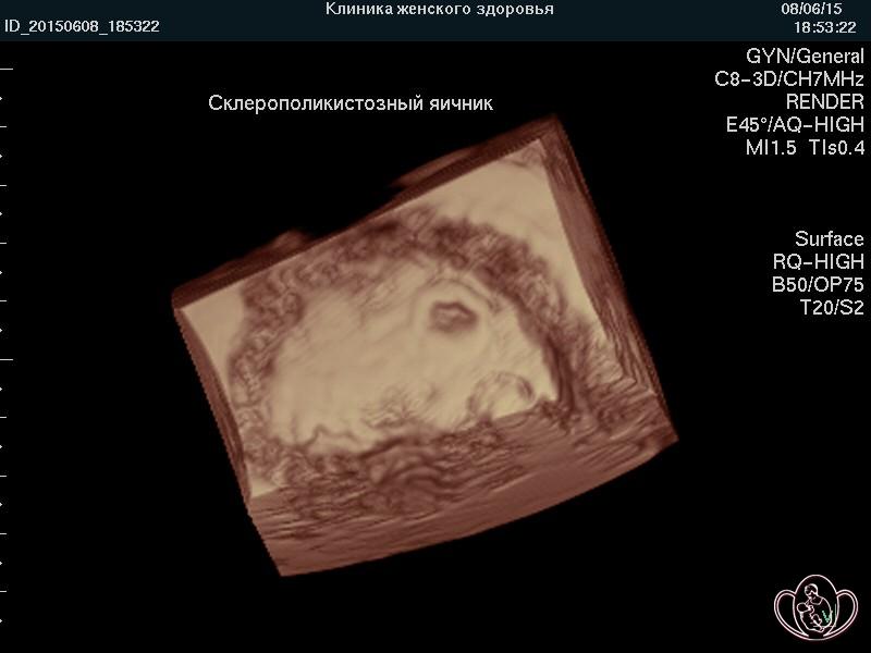 Повышение тонуса сосудов снятие варикоза вен