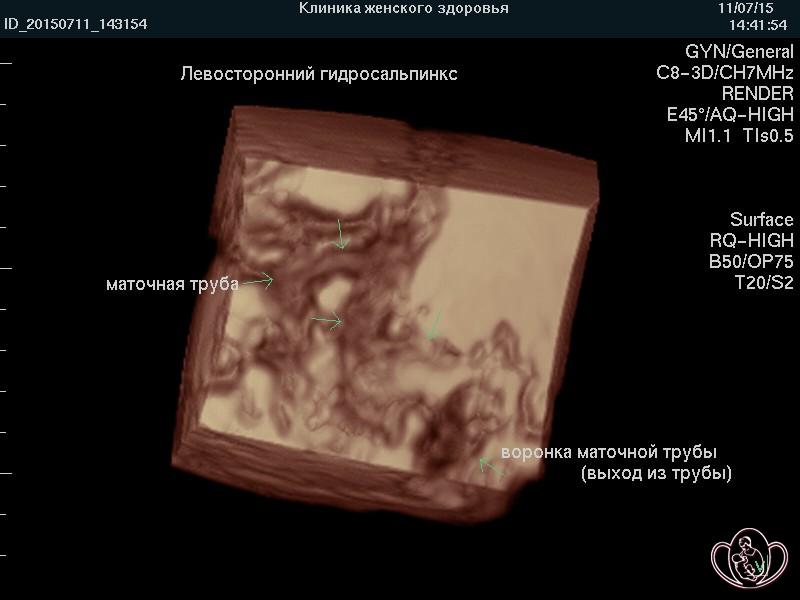 маточная труба не визуализируется что это значит маточная труба не визуализируется что это значит