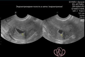 Диффузно-очаговая форма внутреннего эндометриоза. Эндометриома в задней стенке матки