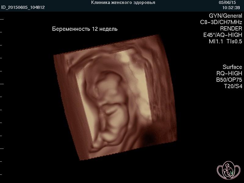 Узи 12 недель беременности сердцебиение