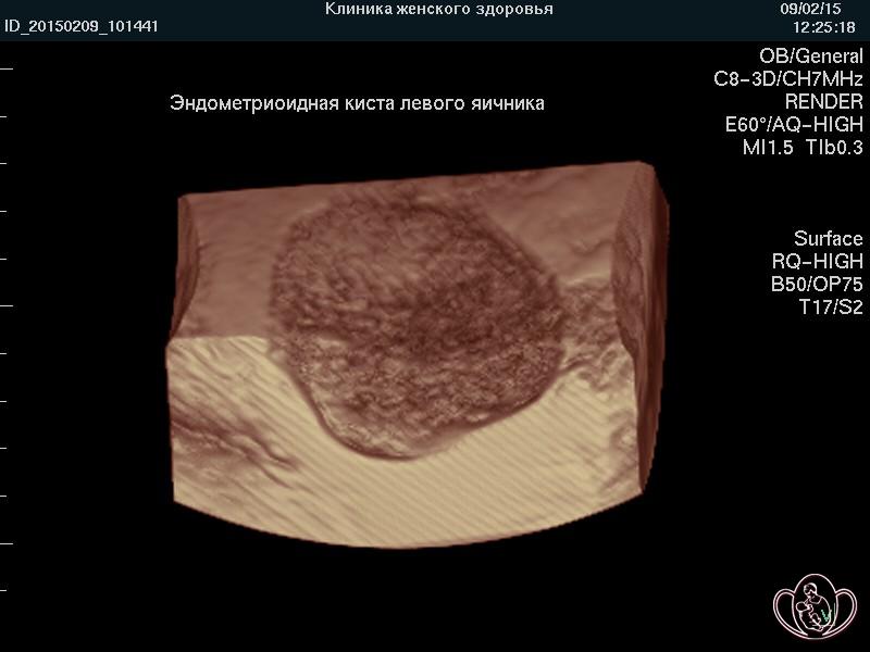 Заболевания шейки матки (эрозия, эктопия)