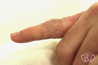 Герпетические везикулы (пузырьки) на указательном пальце левой руки