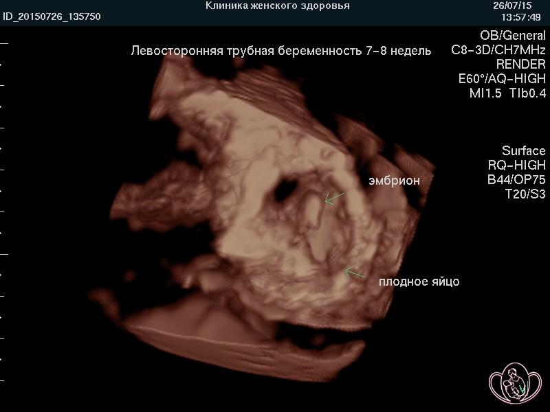 3D-фото внематочной беременности