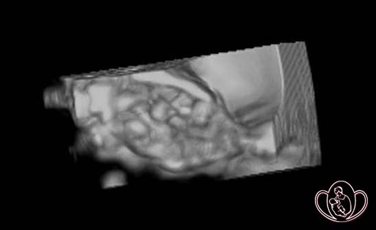 3D-фото правого яичника здоровой женщины 23 лет