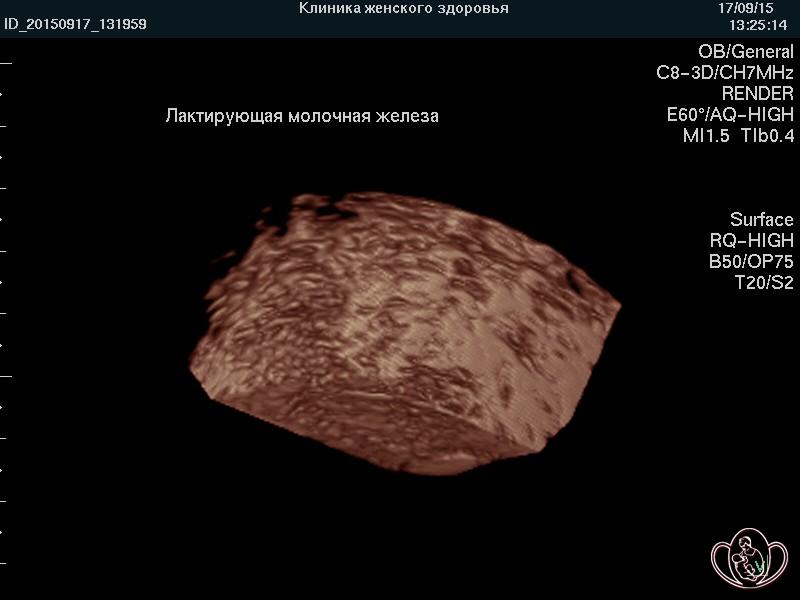 Ультразвуковая маммография: 3D-фото фрагмента ткани молочной железы