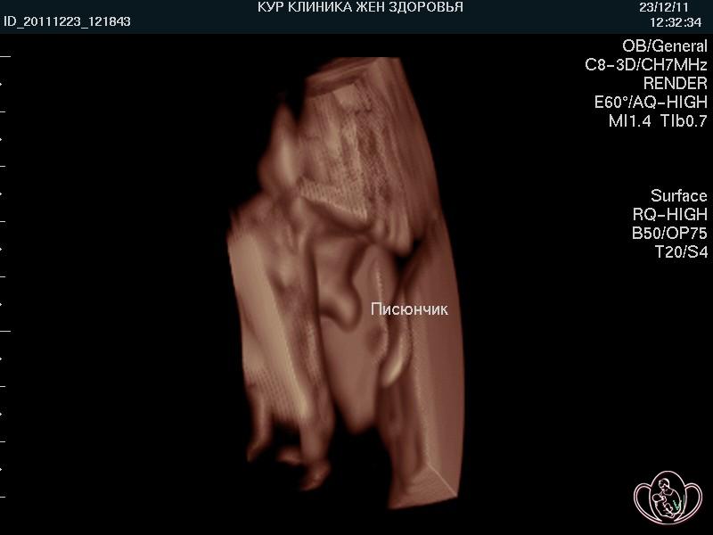 3D-фото полового органа плода 19 недель