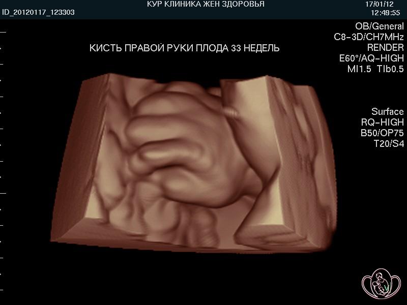 3D-фото кисти правой руки плода 33 недель