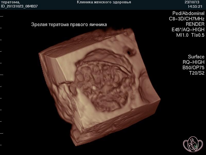 3D-фото зрелой тератомы правого яичника