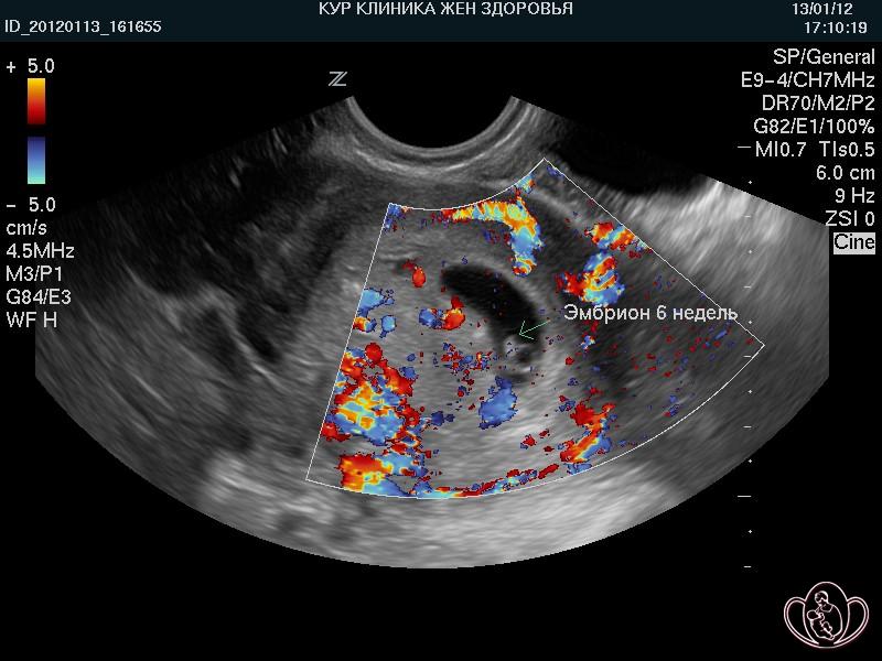 Кровоток в матке при беременности 6 недель