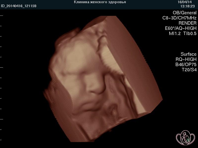 3D-фото лица плода 34 недель