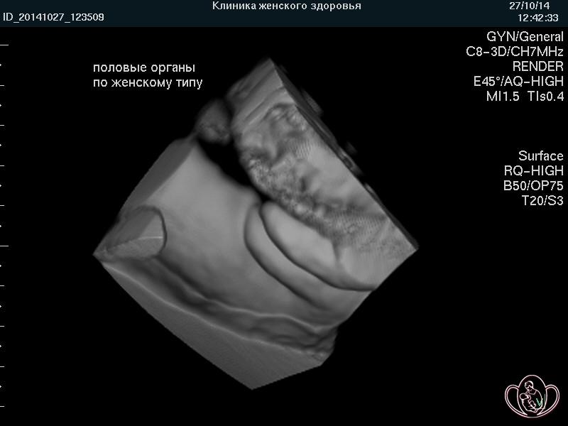 3D-фото наружных половых органов плода 20 недель