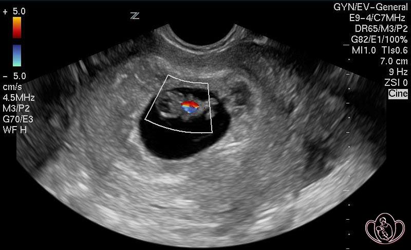 Кровообращение эмбриона 7-8 недель беременности