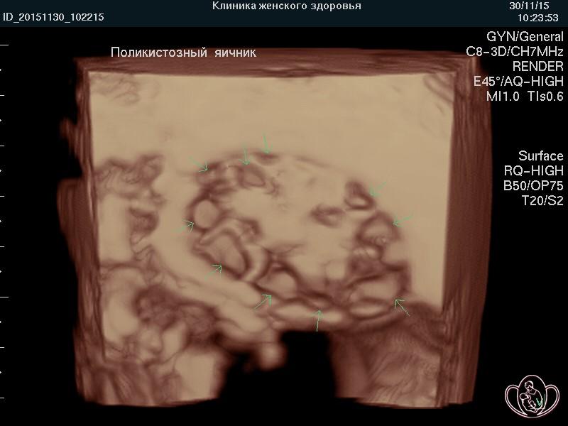 3D-фото поликистозного яичника