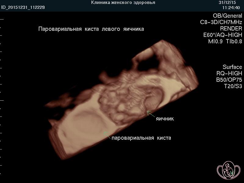 3D-фото параовариальной кисты левого яичника